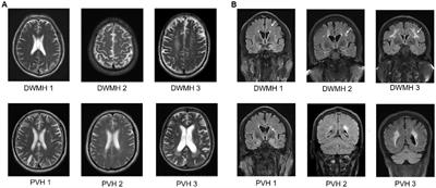 Predicting the severity of white matter lesions among patients with cerebrovascular risk factors based on retinal images and clinical laboratory data: a deep learning study